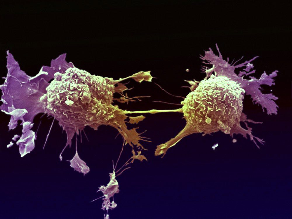 Exploded Cells ‘Exploding’ Cells? Swedish Scientists Discover Potential Cancer ...