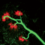 ALS, ALS picture, ALS effects, Brain ALS, Lou Gehrig brain