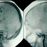 The image on the right shows a dead brain