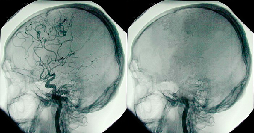 The image on the right shows a dead brain