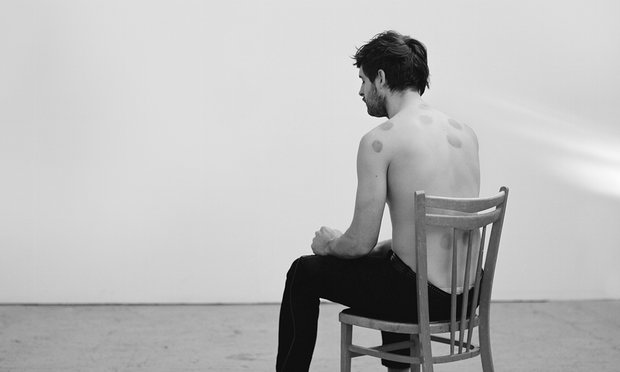 Peter Watkins sits on a chair with bruises all over his upper body made from Chinese cupping therapy