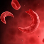 sickle cell disease causes abnormally shaped red blood cells shown here