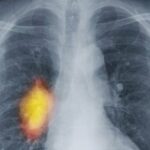 Lungs showing a lung cancer that might respond to early palliative care