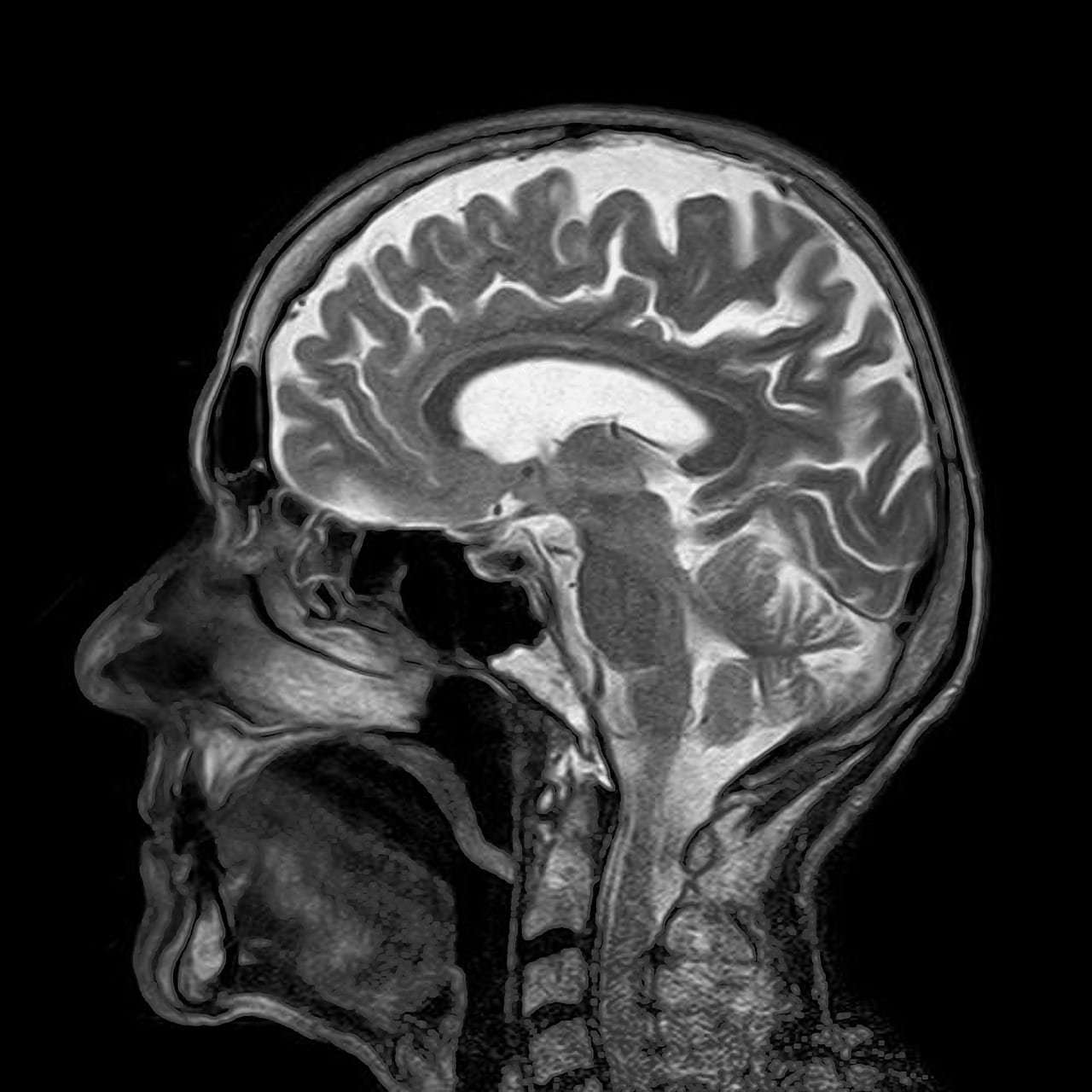 Anti-Inflammatory Drugs May Reverse Cognitive DeclineA new study shows that reducing inflammation in the brain can improve cognitive ability