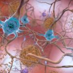 beta amyloid affecting brain cells in Alzheimer's disease